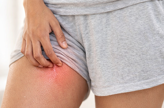 Inner Thigh Chafing in Summer: Causes & Prevention Tips