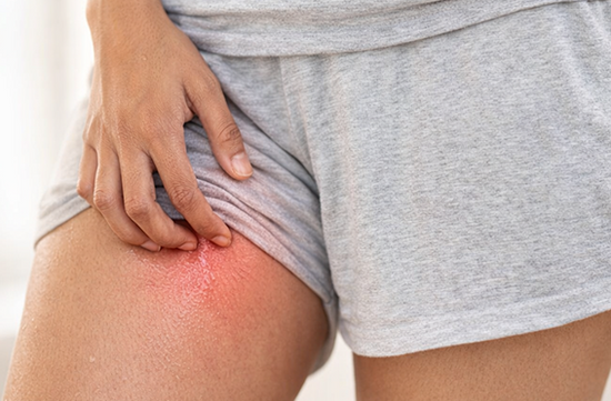 Inner Thigh Chafing in Summer: Causes & Prevention Tips