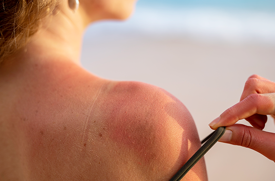 How to Keep Your Skin Calm & Rash-Free in Hot Weather?