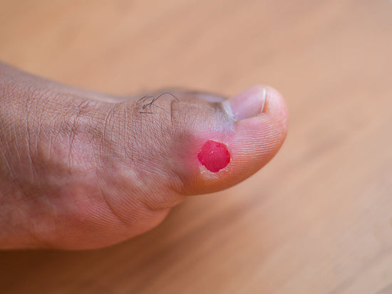 Shoe Blisters : Why Does it Happen and How to Prevent it?