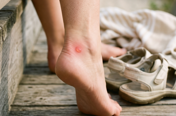 A close-up of a person’s bare foot with a small red, irritated spot on the back of the heel, standing beside a pair of shoes. The image highlights discomfort caused by shoe friction or shoe bites.