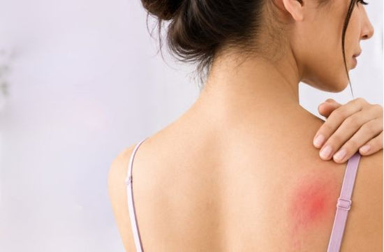 Bra Rash
