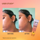 SkinEasi Acne & Scar Gel| Helps Treats Acne and Reduces Acne Scar | For Him & Her | 15 GM