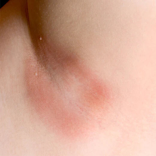 Armpit Chafing