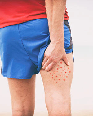 Inner Thigh Chafing